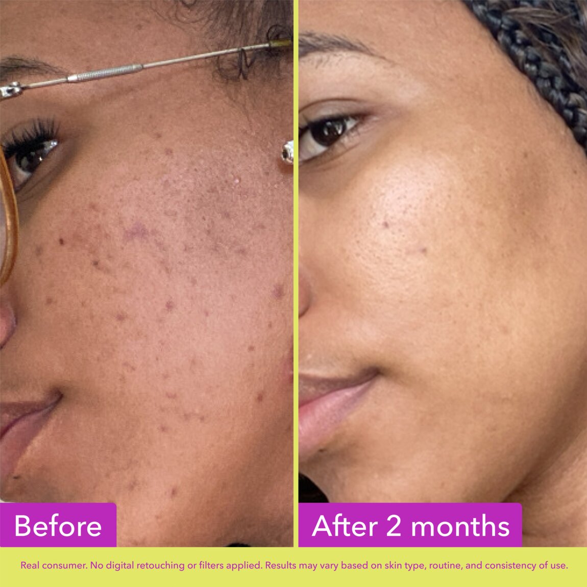10% Azelaic Acid Treatment V1