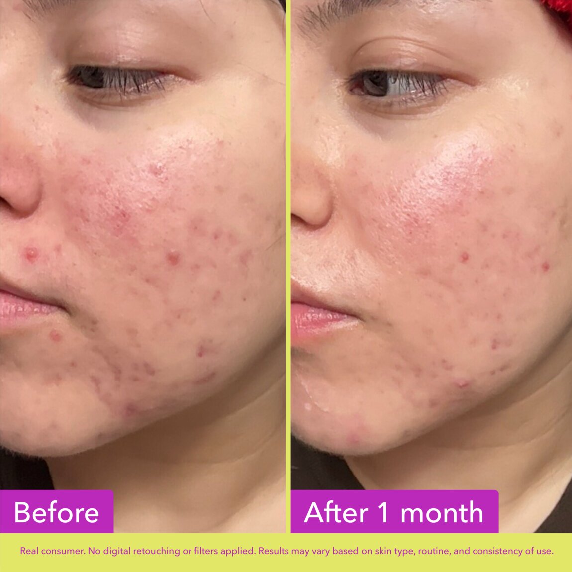 10% Azelaic Acid Treatment V1