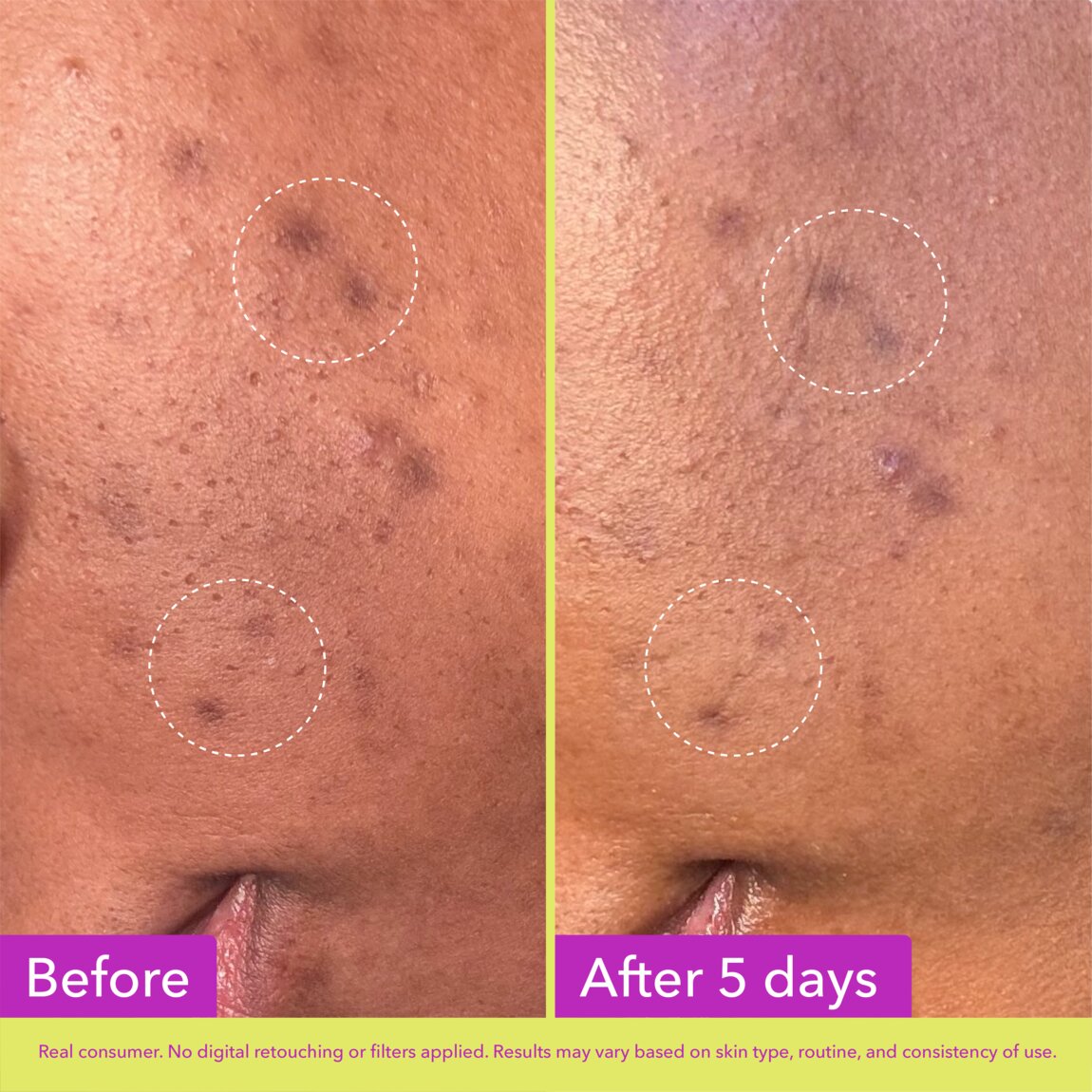 Dark Spot Microdart Patches H5