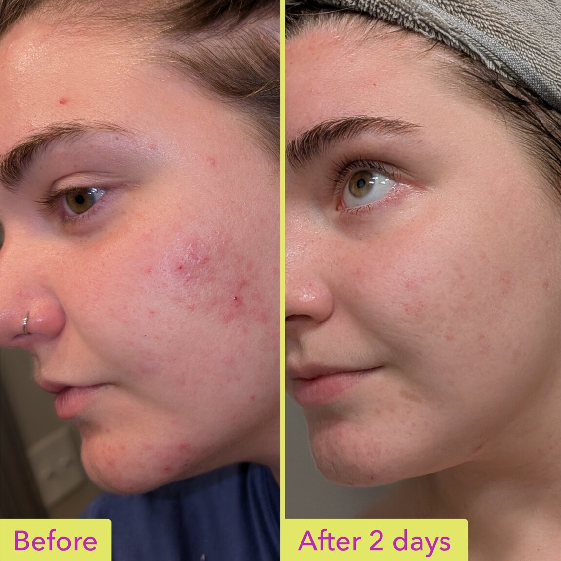 10% Azelaic Acid Treatment V1
