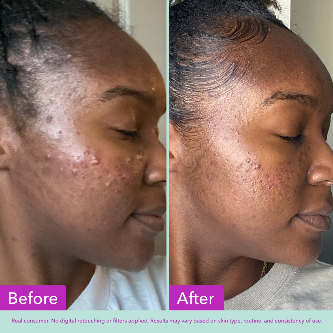 Acne Foaming Cleanser U1