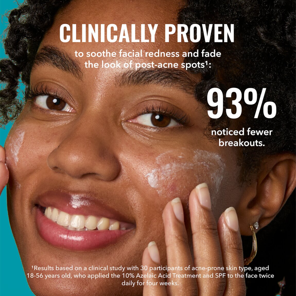 10% Azelaic Acid Treatment J4