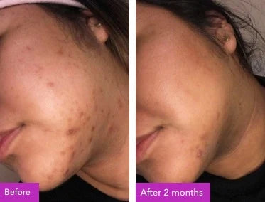 Before and after result